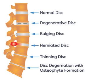 herniated disc sciatica footdrop ash_shahin