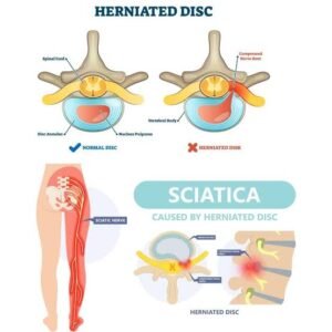 herniated disc sciatica footdrop ash_shahin