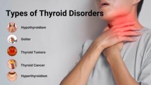 Thyroid gland and treatment with ashrafshahin..com