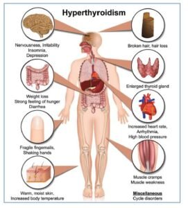 Thyroid gland and treatment with ashrafshahin..com