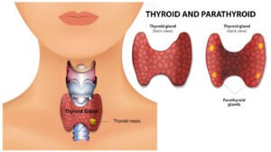 Thyroid gland and treatment with ashrafshahin..com