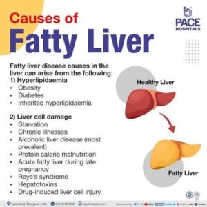 Fatty liver disease 